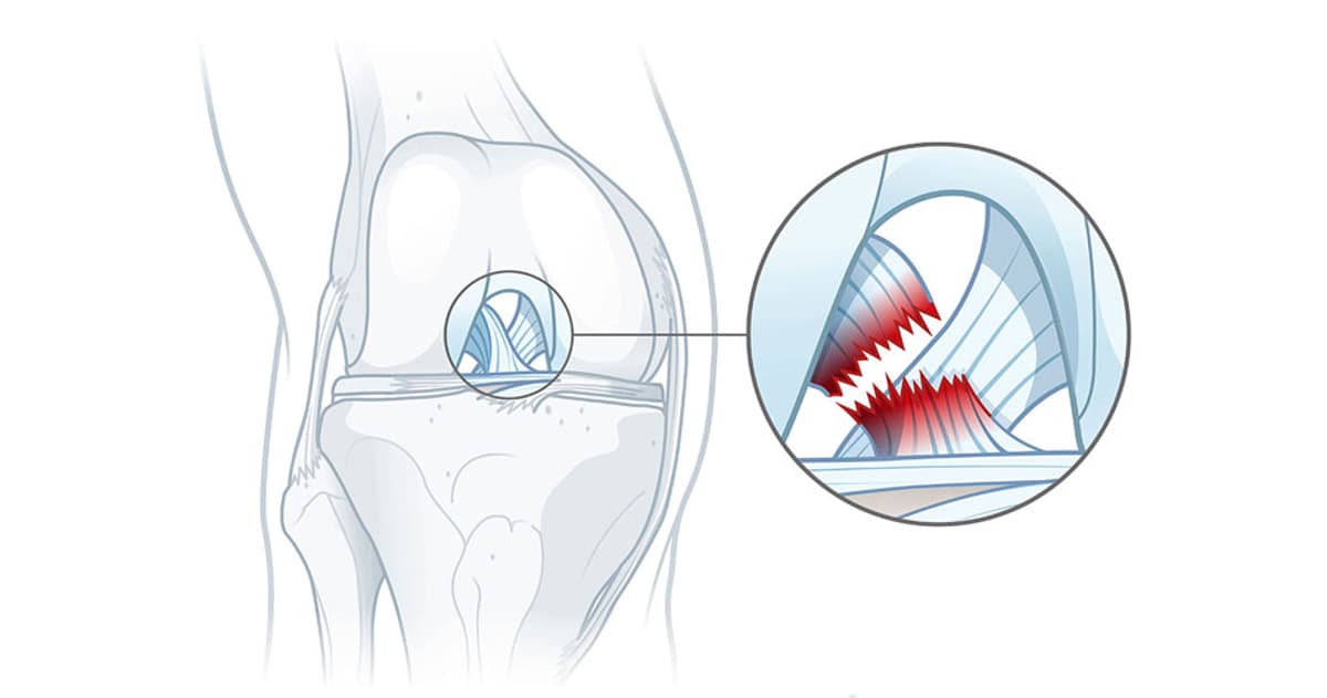 Knee Screening: Integrating Performance Training with Clinical Insight