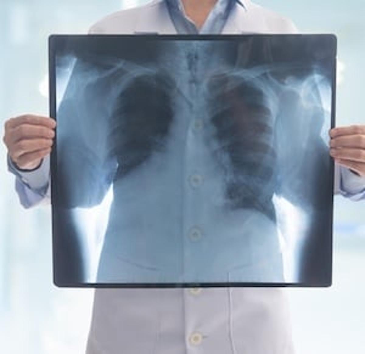 Researchers: FDA-Cleared Chest X-Ray AI Shows Promise in Missed Lung Cancer Detection