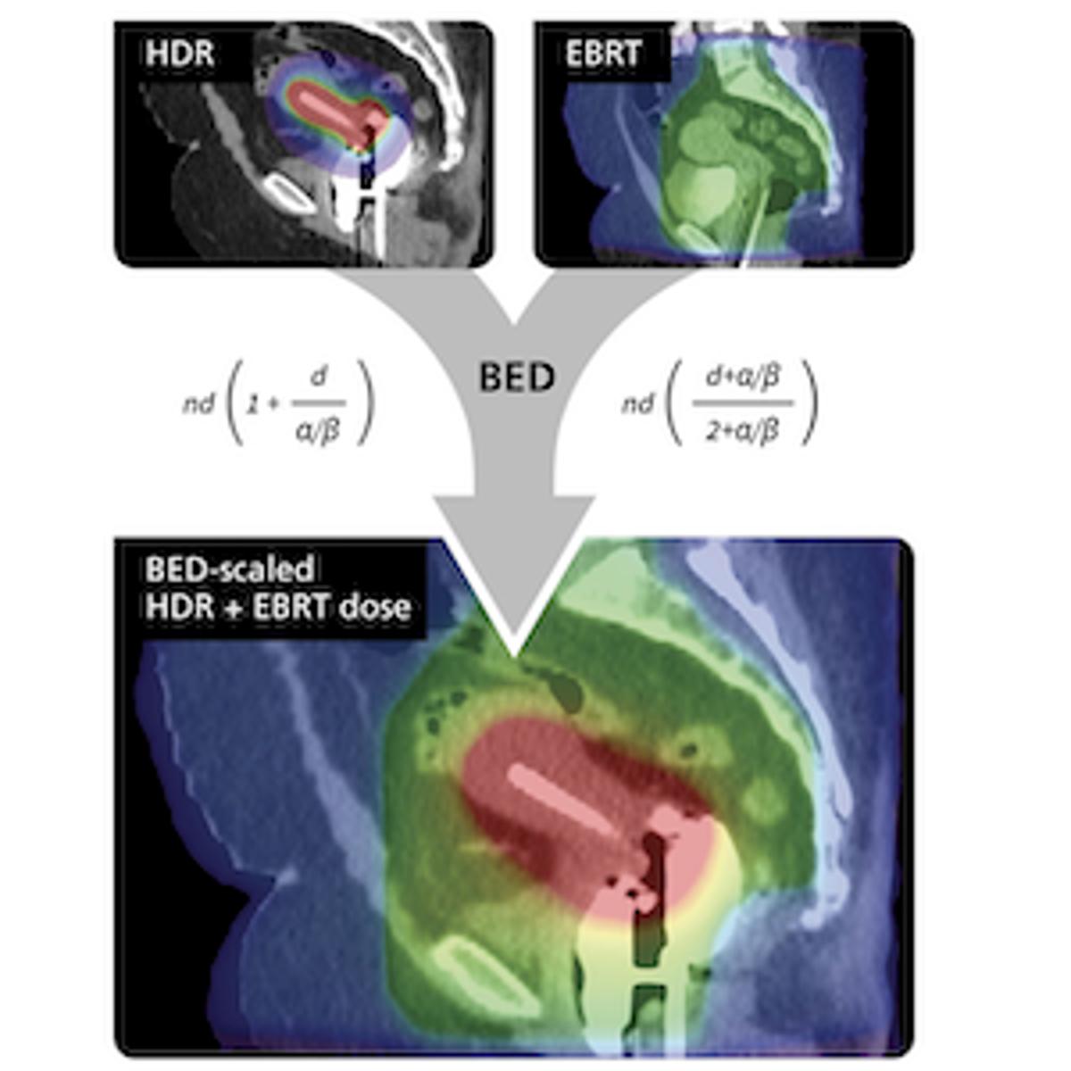 GE HealthCare Offering ComboTherapy GYN HDR/EBRT for Precision Gynecologic Cancer Care