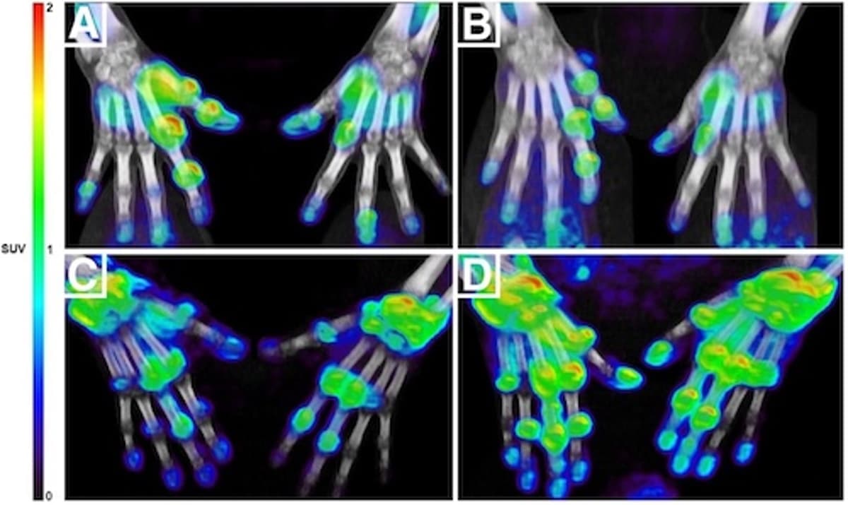 Targeted PET/CT Tracer Helps Rheumatoid Arthritis Patients