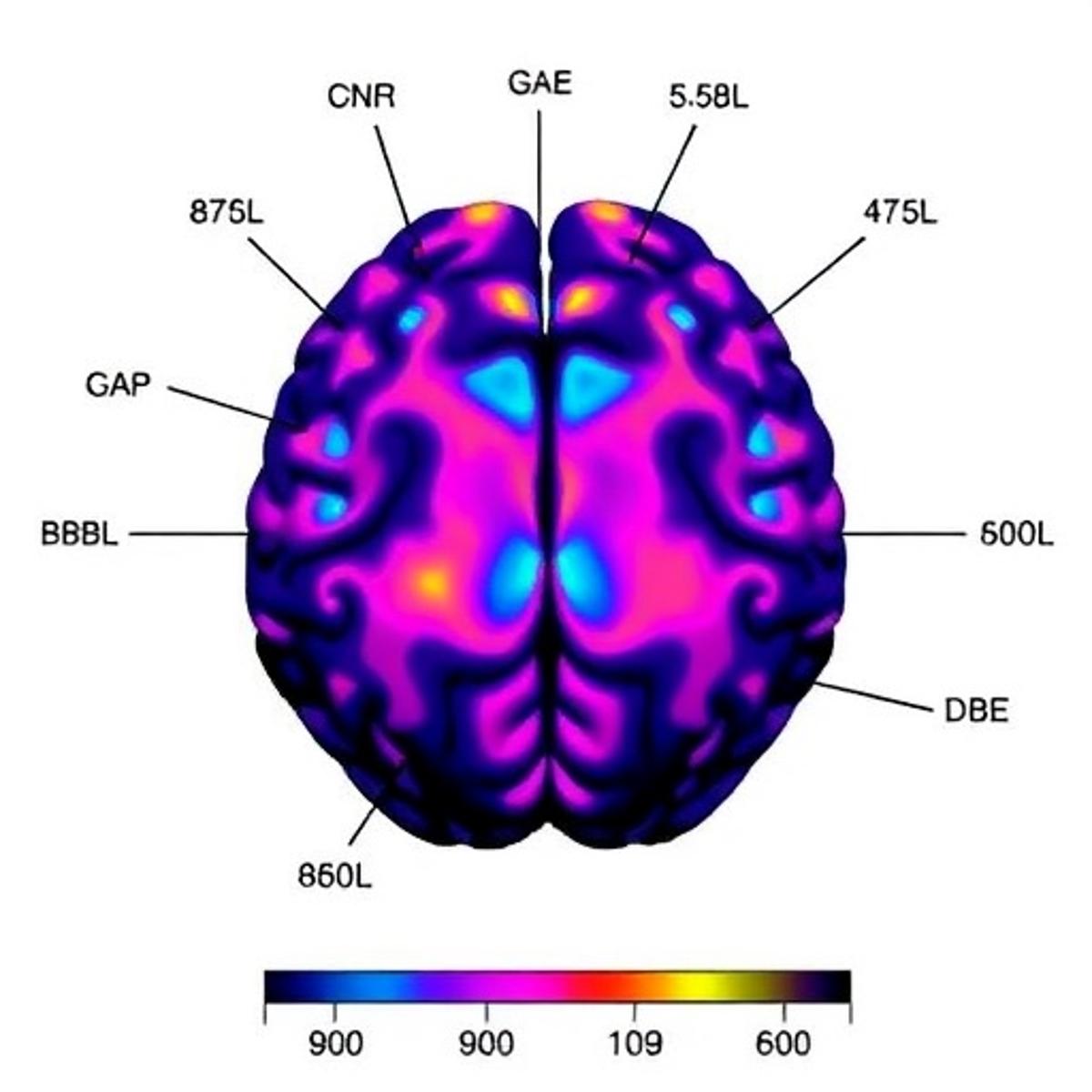 Lipid Profiles in Amygdala: Sporadic vs GBA Parkinson’s