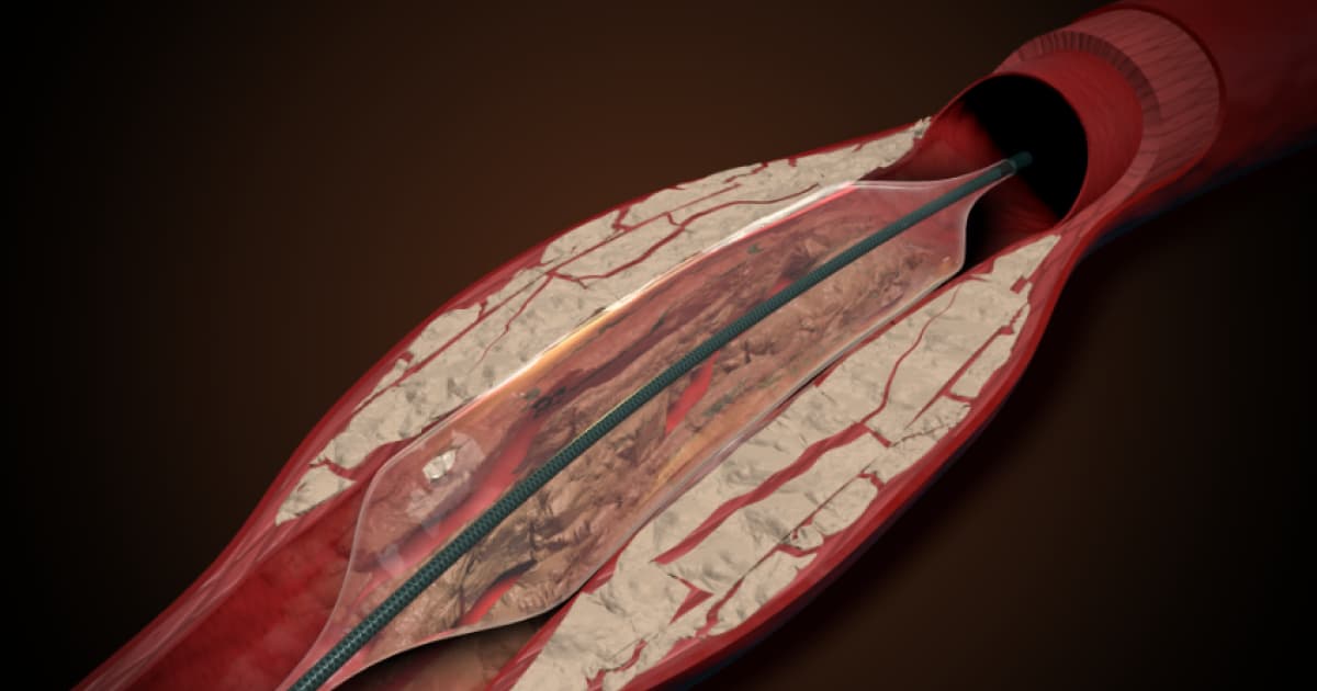 Stryker to Acquire Amplitude Vascular Systems, Expanding IVL Portfolio