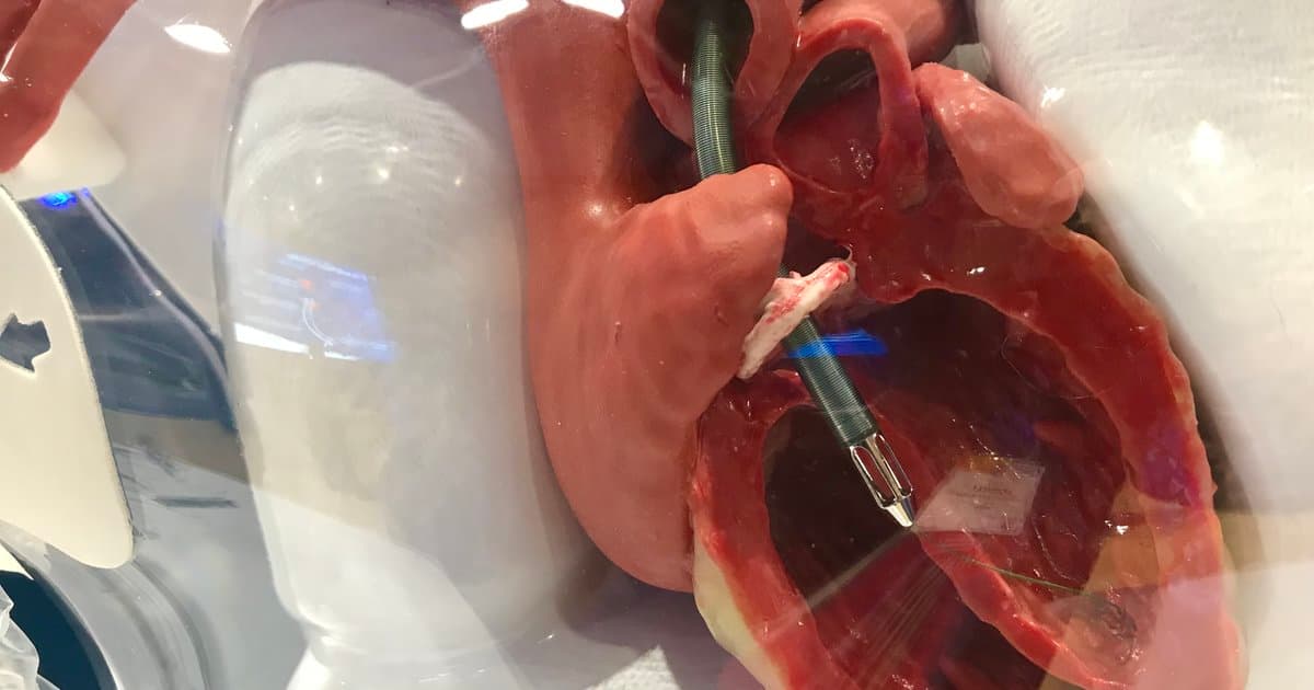 Impella 5.5 Shows Promise in Certain Non-Shock, High-Risk Cardiac Surgery Patients