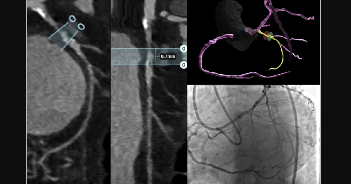 CCTA Brings Clarity, Better Outcomes to CTO PCI