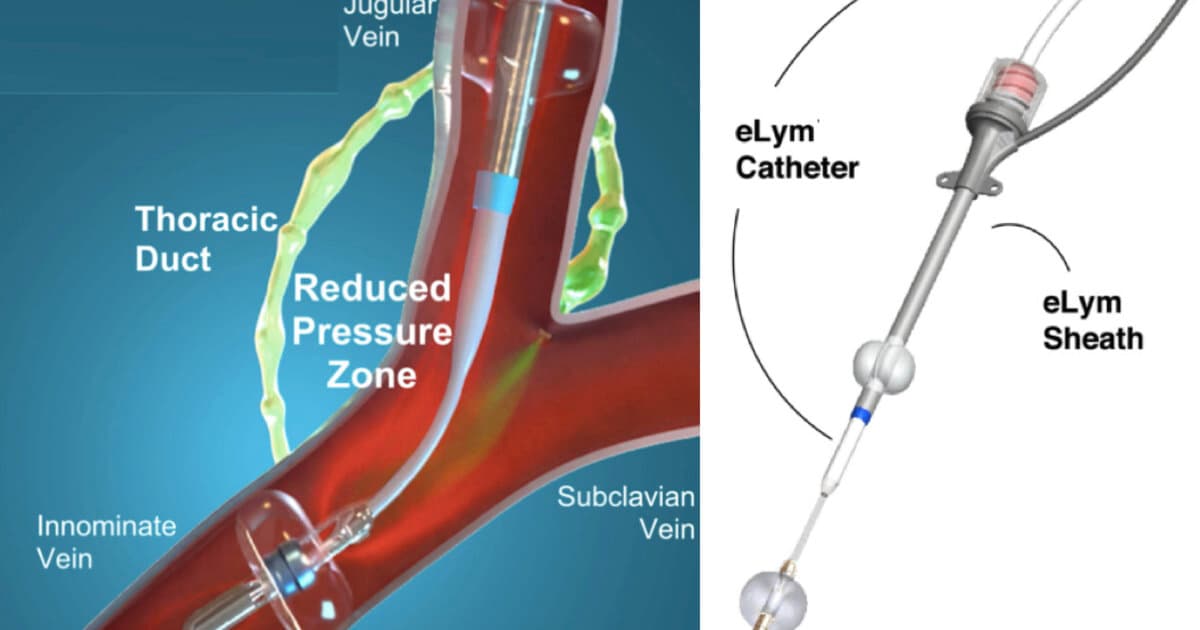 First-of-Its-Kind Drainage Device Helps Limit Heart Failure Rehospitalizations