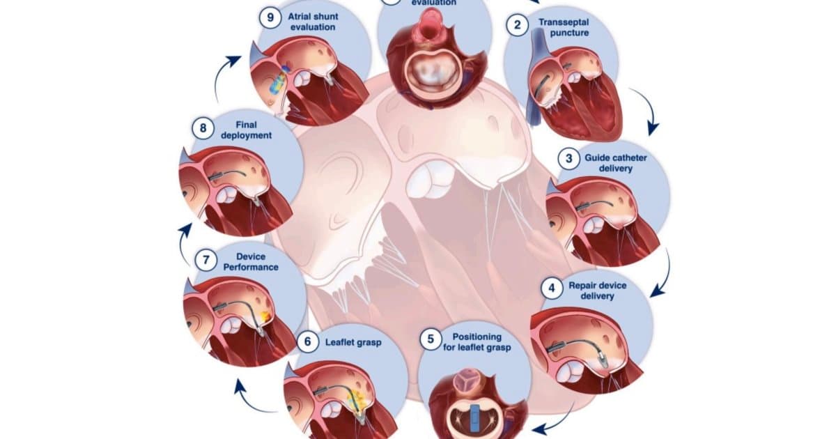 New Guideline Standardizes Echo Guidance for Mitral Transcatheter Edge-to-Edge Repairs