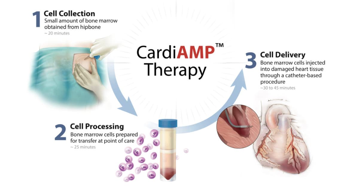 BioCardia Raises $4.4 Million in Financing for Its Heart Failure Cell Therapies