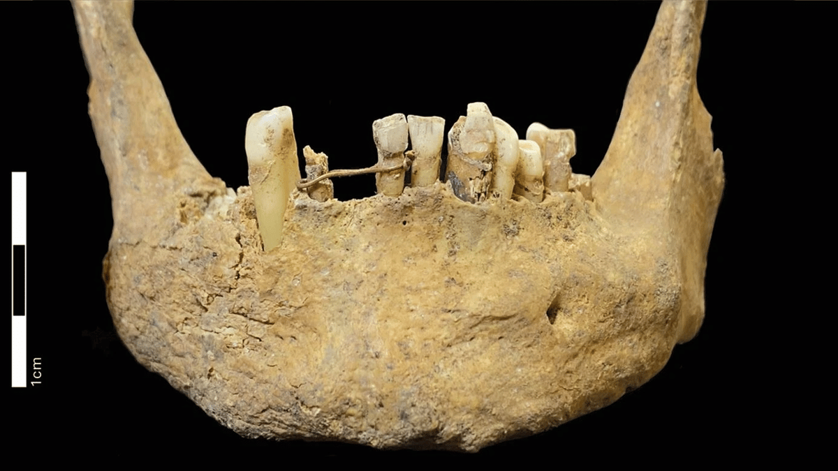 500-Year-Old Gold Dental Bridge Is Earliest Known Oral Care of Its Kind in Scotland — and It Likely Held a...