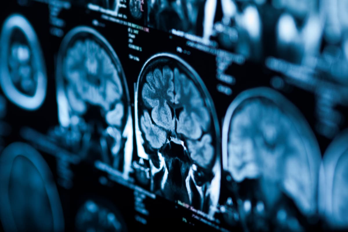 AI Learning Model Predicted Cognitive Status in Patients With MS
