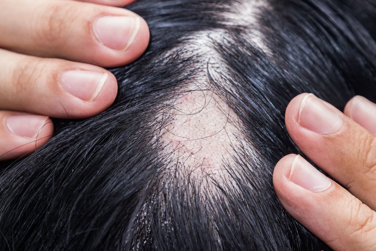 Deuruxolitinib Demonstrates Consistent Efficacy, Early Hair Regrowth in Severe Alopecia Areata