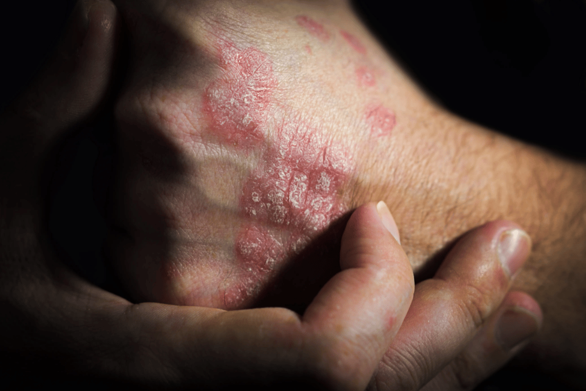 Simplified Psoriasis Severity Measure Shows Strong Correlation With PASI