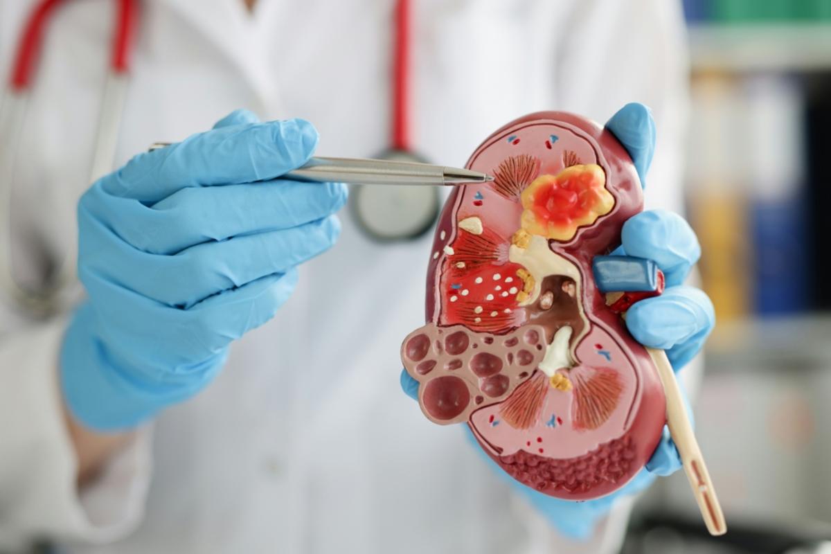 SERB to Pay Hansa €110M Upfront for EU Rights to Kidney Transplant Drug