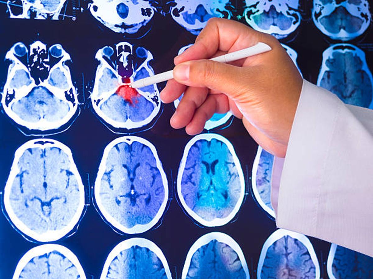 How the Depo-Provera Brain Tumor Lawsuit Works
