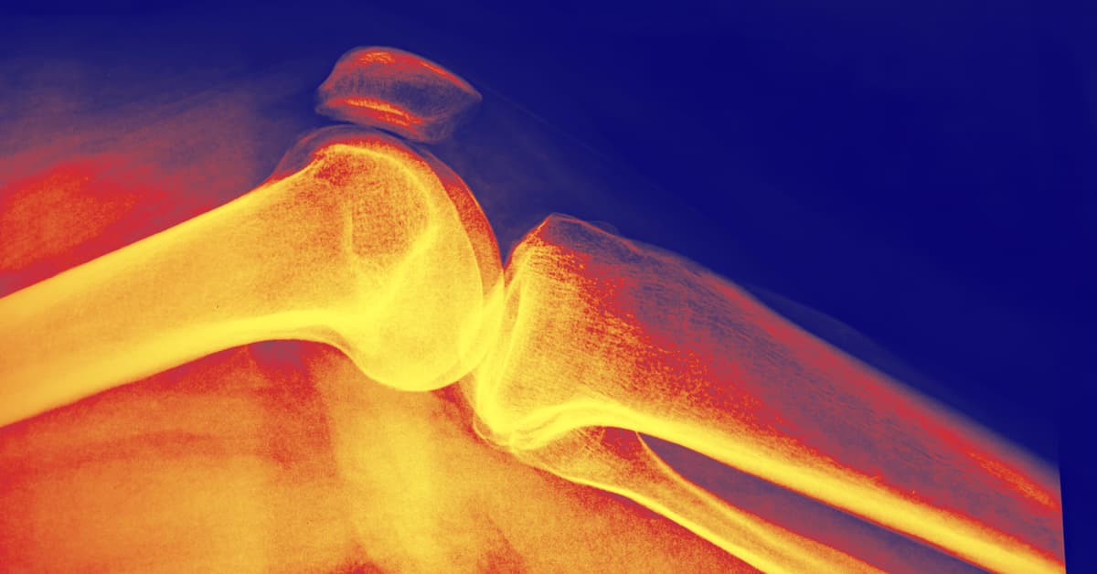 How Long Does It Take to Increase Bone Density?