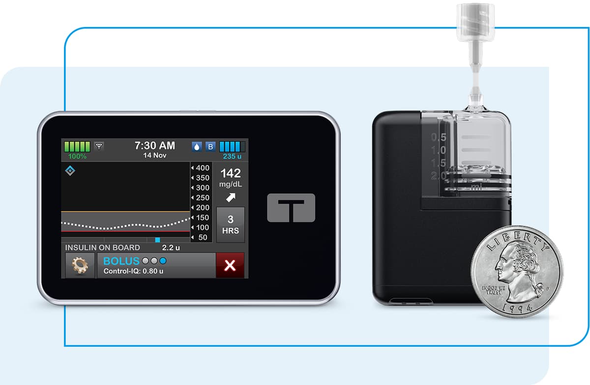 FDA Clears Tandem Control-IQ+ for Type 1 Diabetes During Pregnancy: First AID System to Earn Indication
