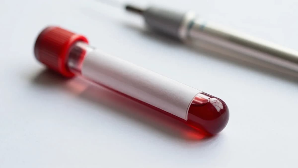 Association of D-Dimer and Fibrinogen Levels with Stroke Severity in Acute Ischemic Stroke Patients: A Cross-Sectional Study at a Tertiary...