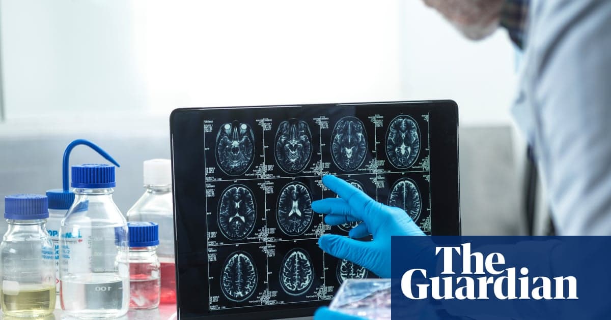 Slow Alzheimer’s Diagnoses ‘Mean UK Patients Missing Out on Experimental Treatments’