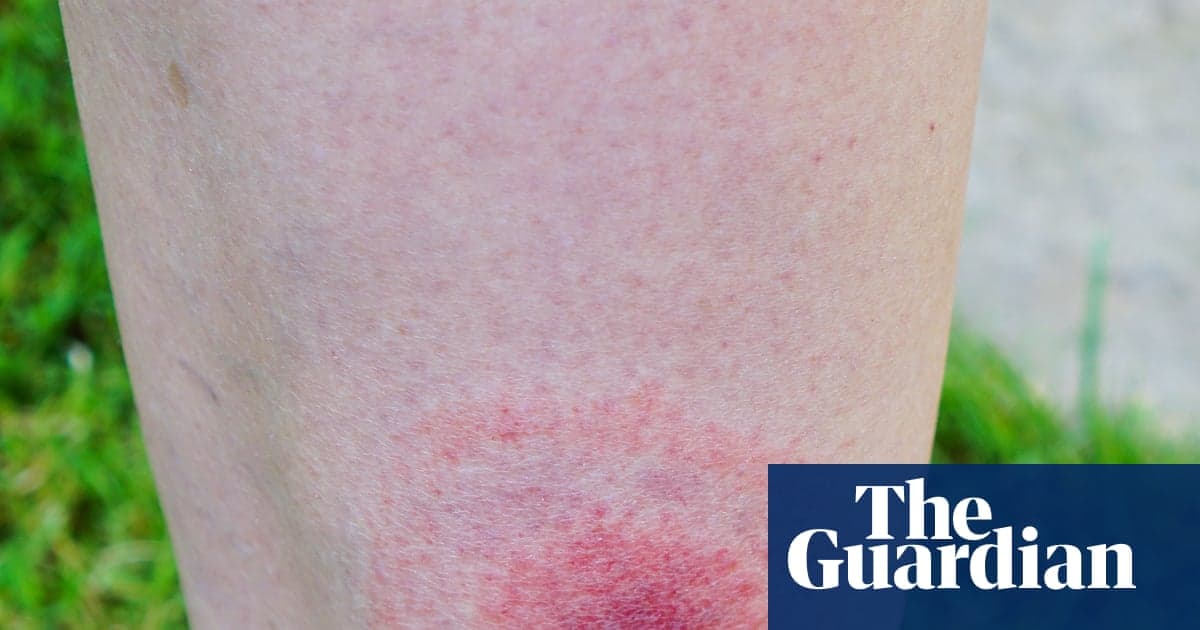 Lyme Disease Cases in England Rise by More than 20% in a Year