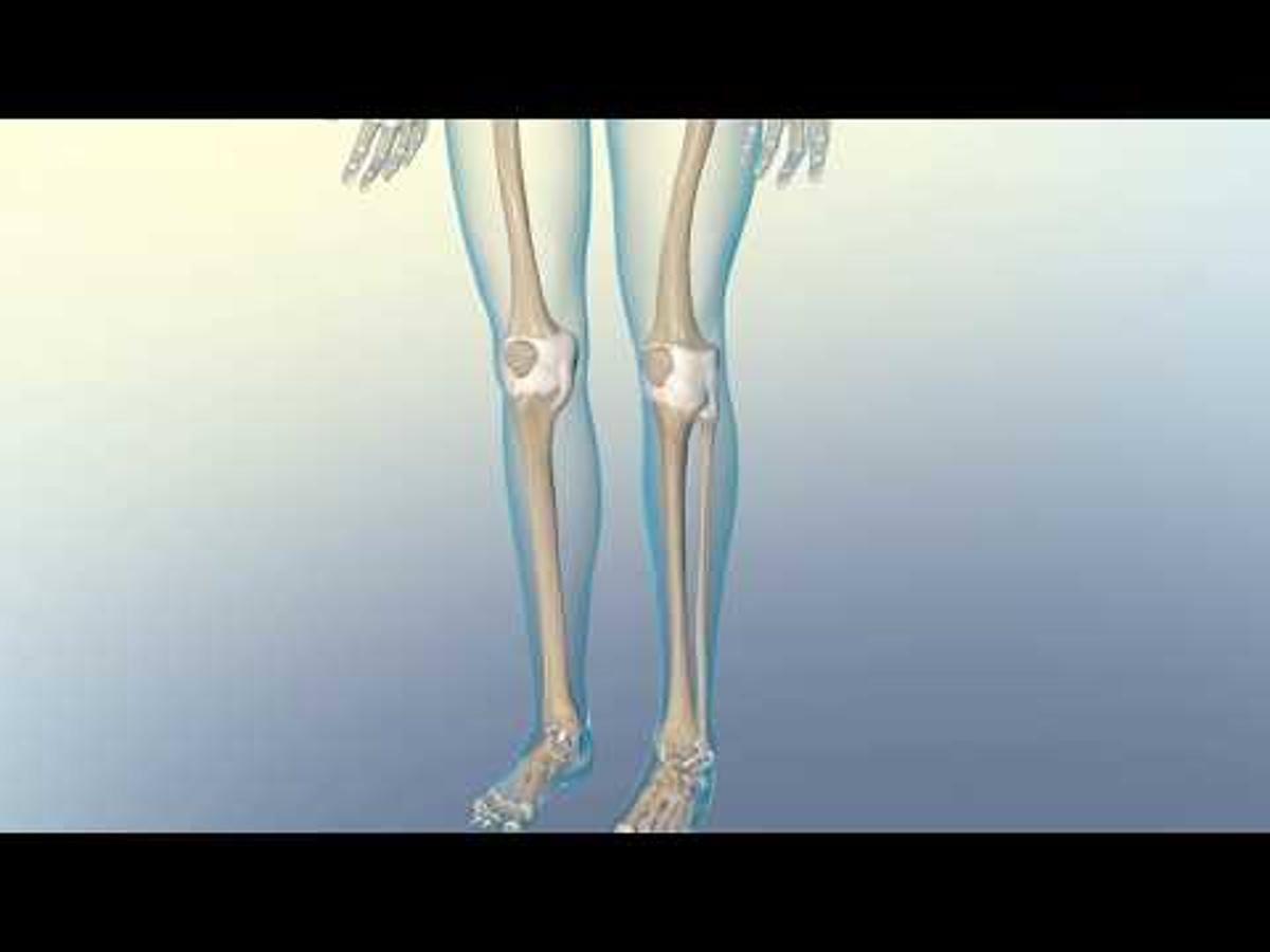 Understanding Osteoarthritis Vs. Rheumatoid Arthritis
