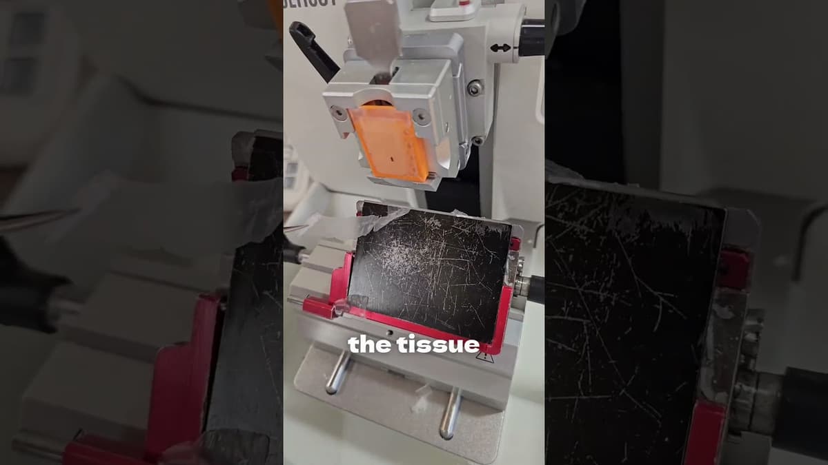 Understanding Breast Biopsies