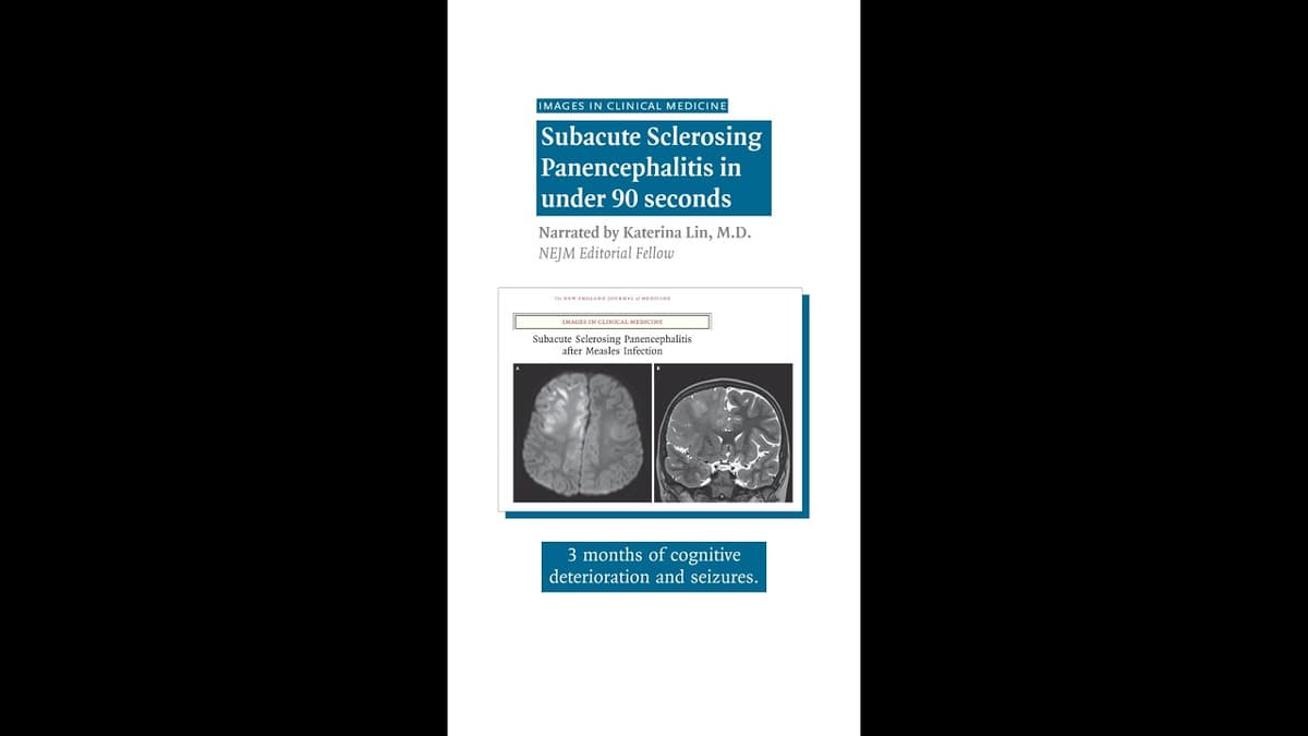 Subacute Sclerosing Panencephalitis