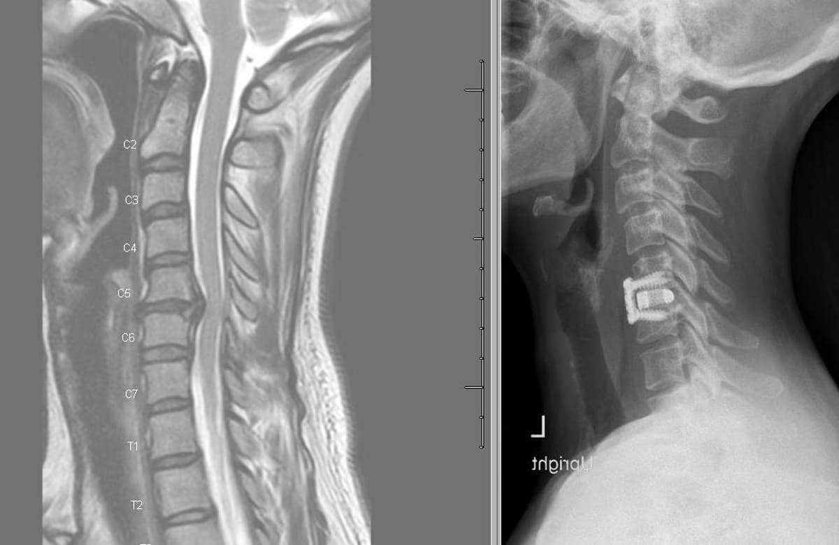 Will Insurance Cover Neck Surgery Implants? Spine Societies Speak Out