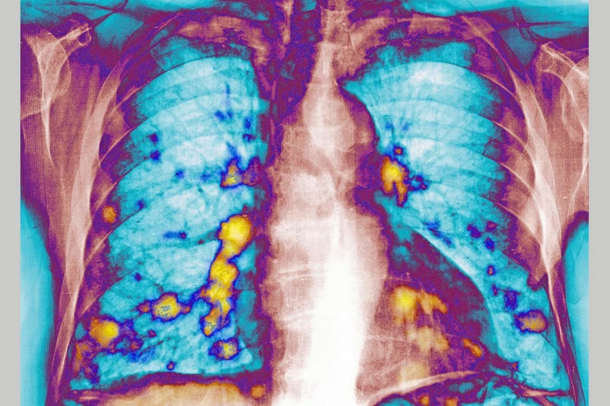 Catching a Cold Can Delay Cancer From Spreading to the Lungs