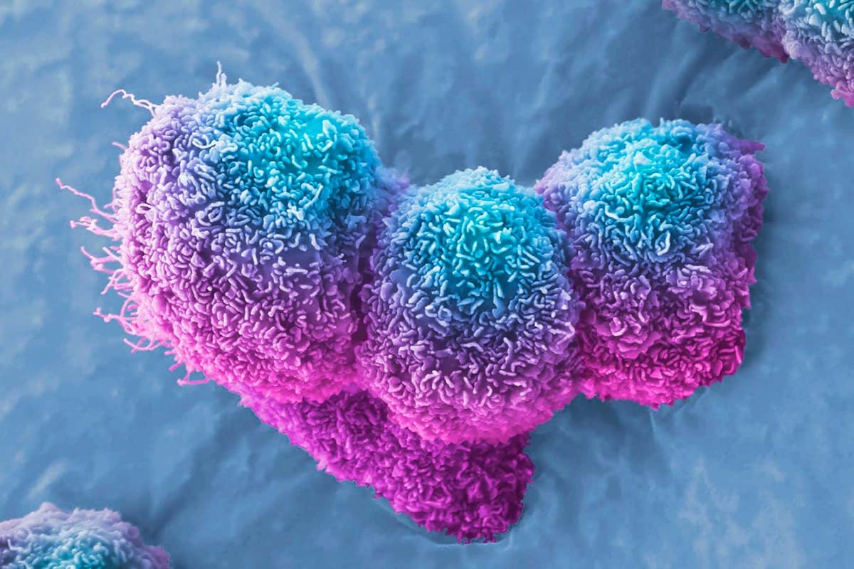 Pancreatic Cancer Halted by Virus Injection in Three Patients