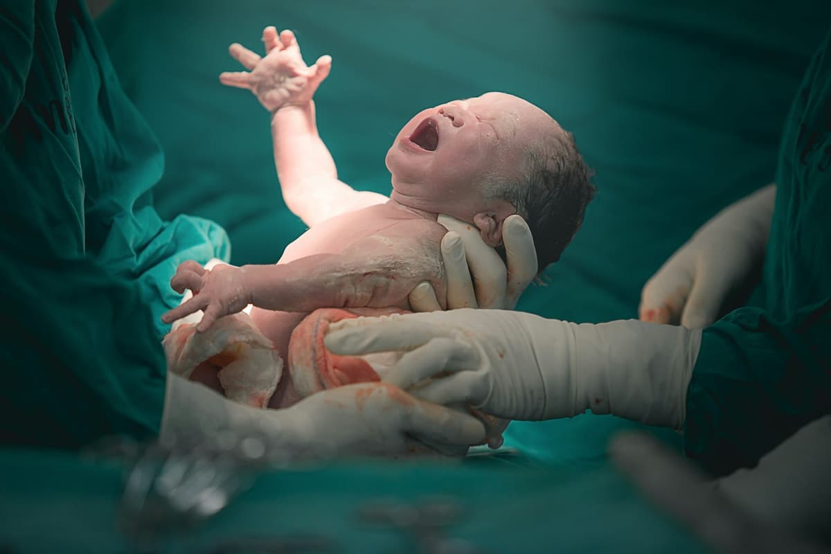 Why More Births Now End in Caesarean Section