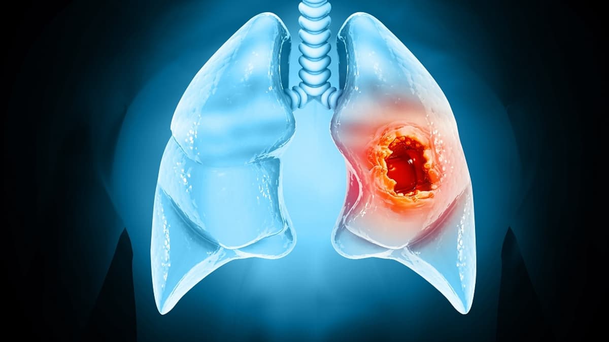 Early Cancer Cells Change Their Surroundings to Form Tumors