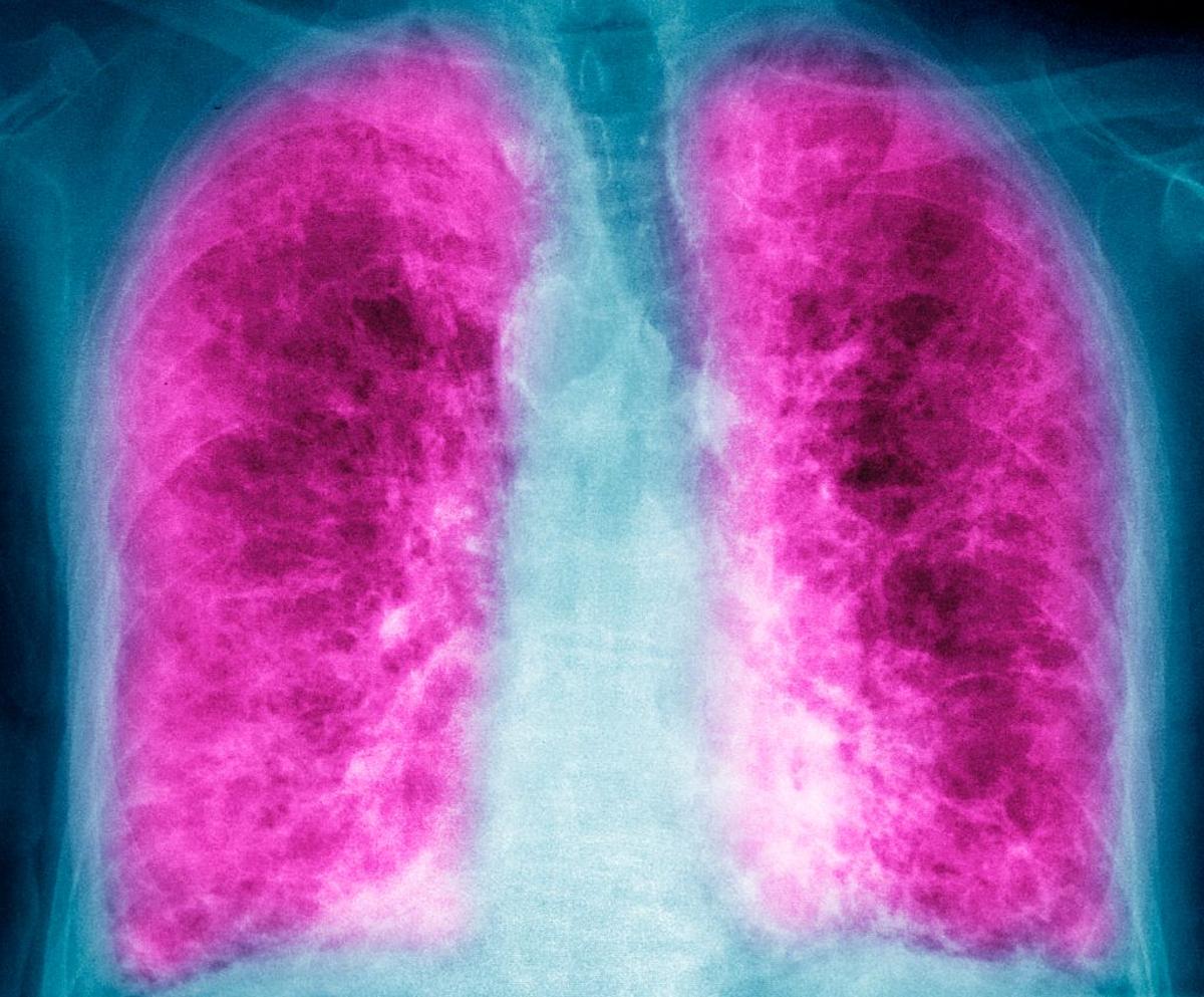 Avalyn Pharma Takes a Breath to Raise $300M in IPO Cash for Lung Drug Trials