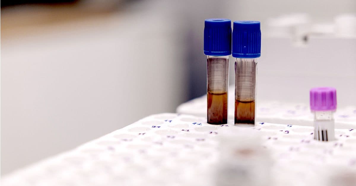 Could Anemia Increase the Risk of Developing Dementia?