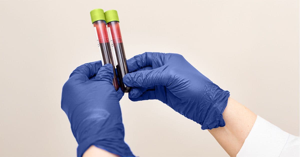 Alzheimer’s Blood Test Around Ages 53-69 May Help Detect Early Cognitive Decline