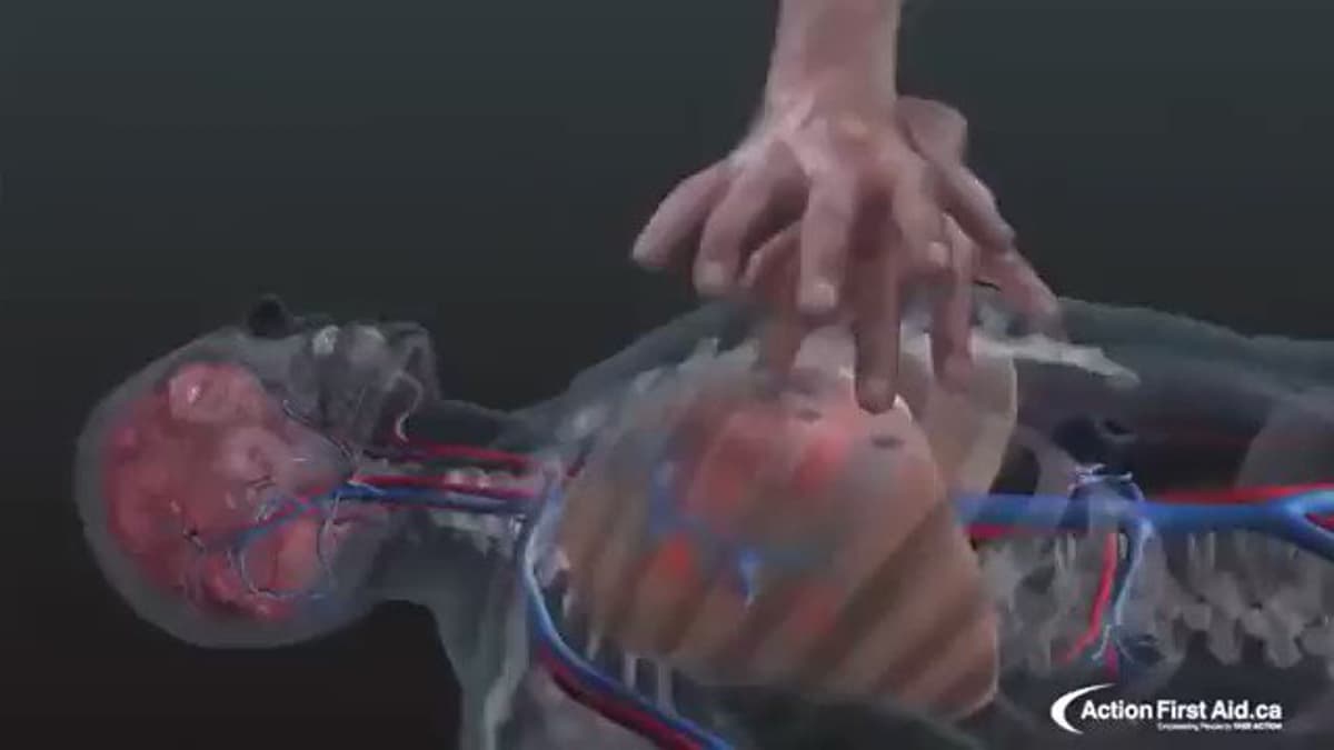 CPR Doubles or Triples Cardiac Arrest Survival Rates