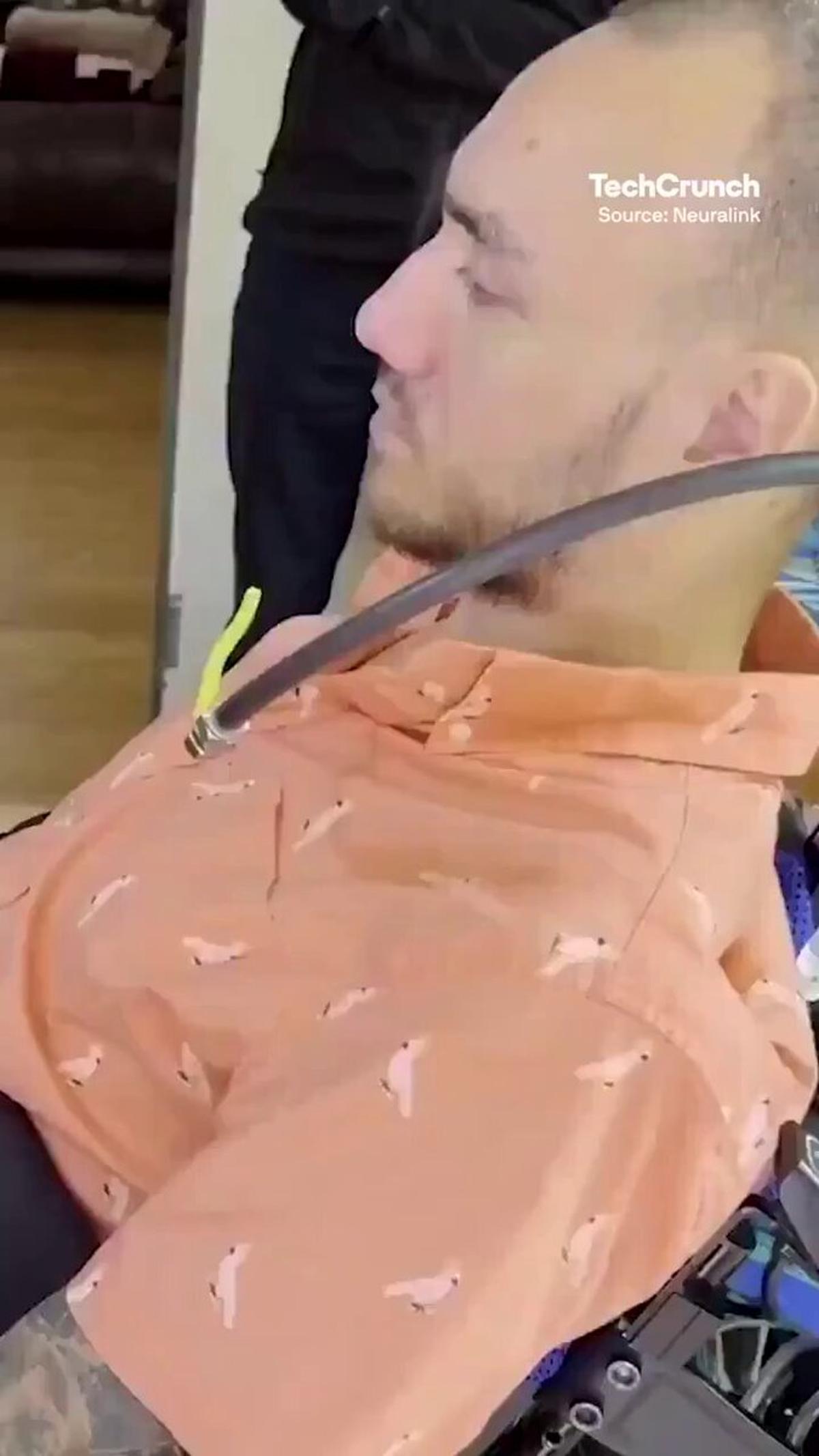 First Human Controls Cursor Using Only Thoughts