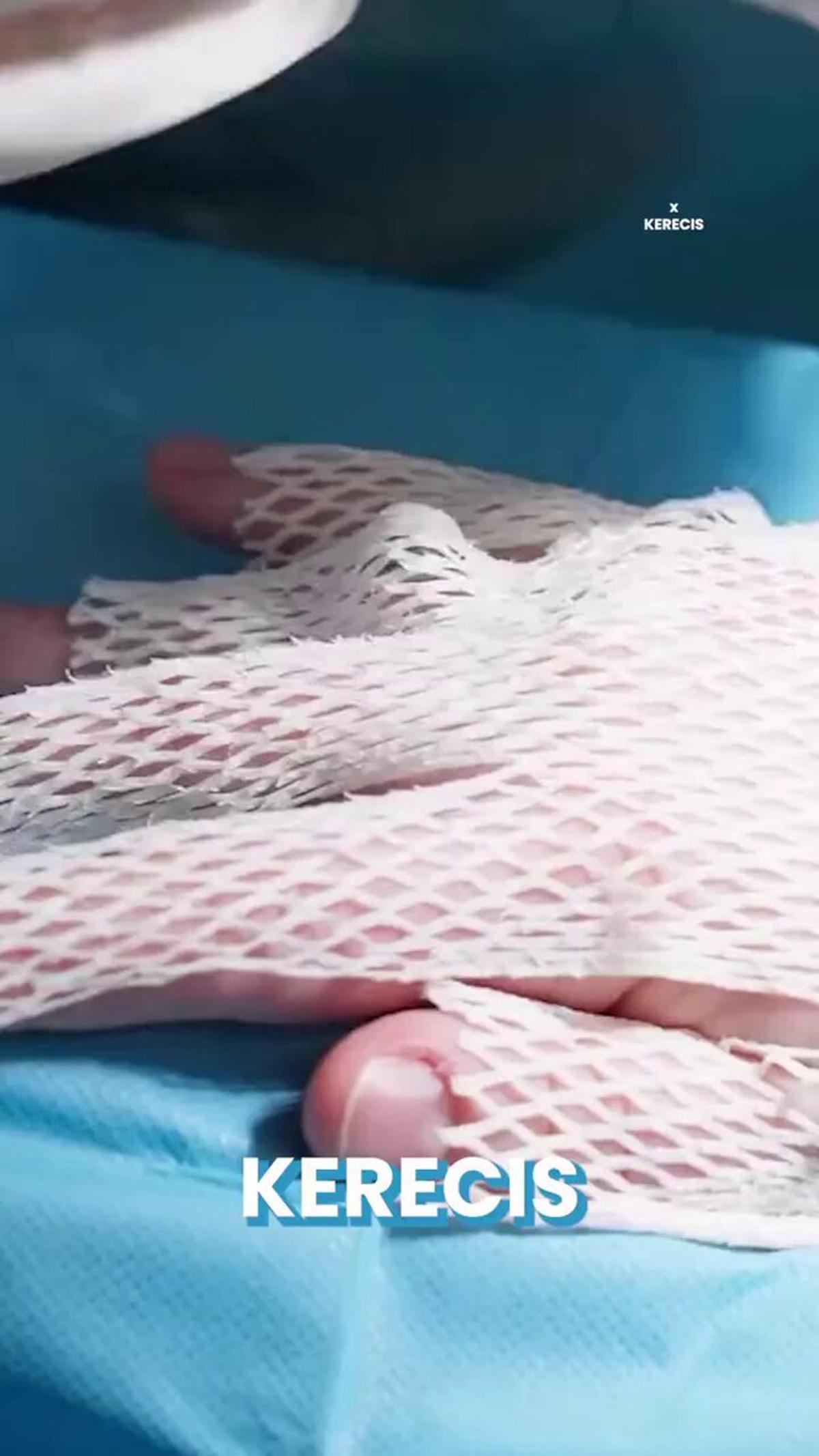 Fish‑skin Graft with Silicone Accelerates Wound Healing