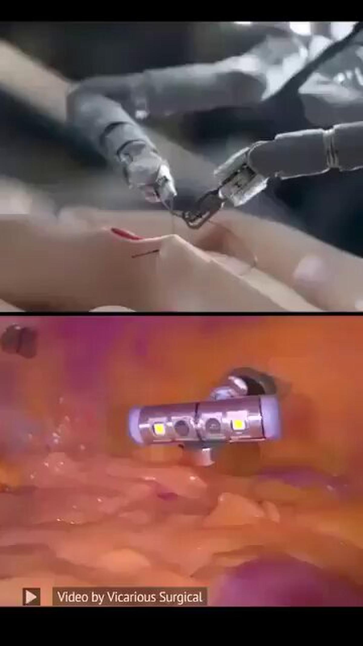 Tele‑Operated Micro‑Robot Delivers Ultra‑Precise Minimally Invasive Surgery