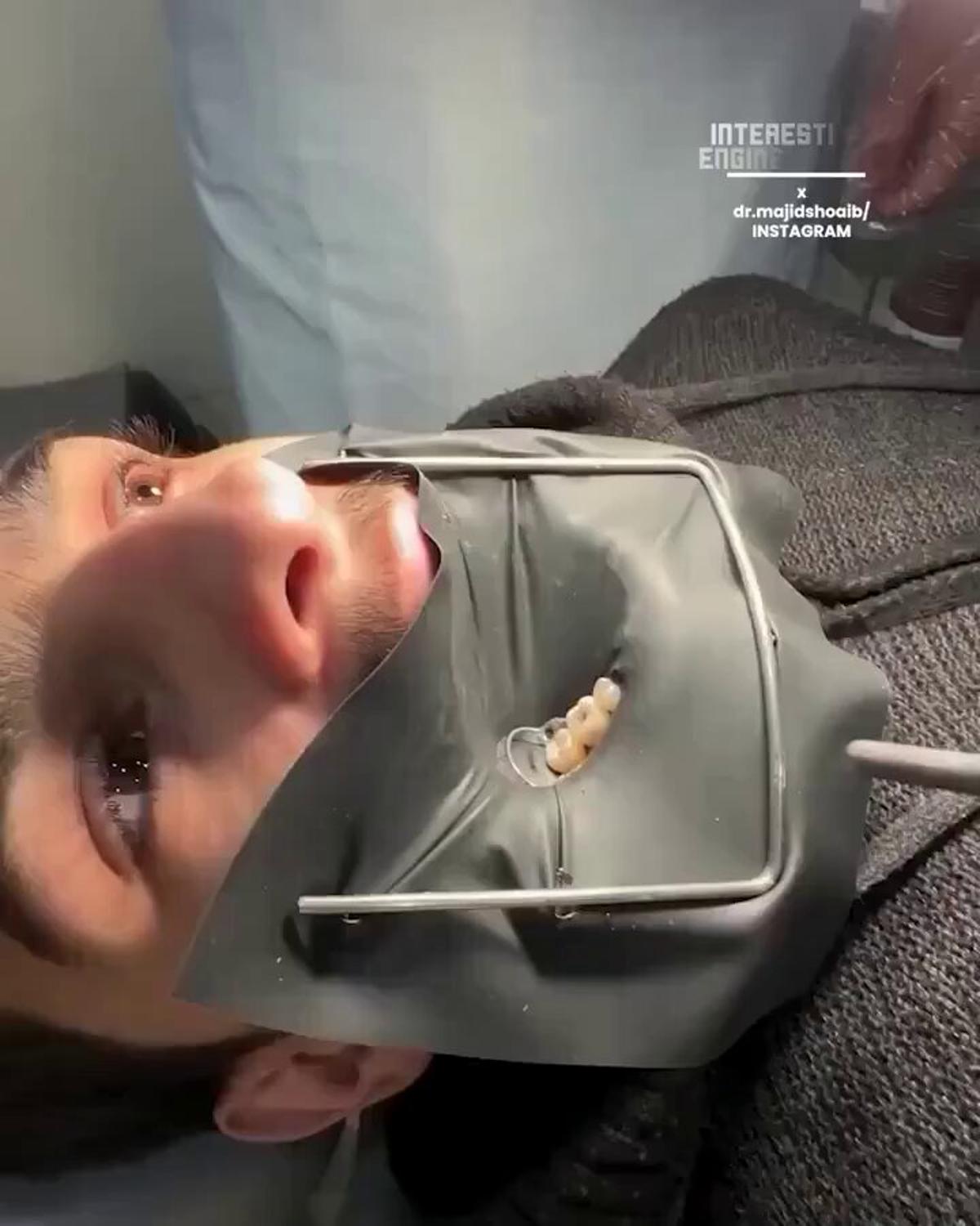 Rubber Dams Enable Precision in Modern Dental Care