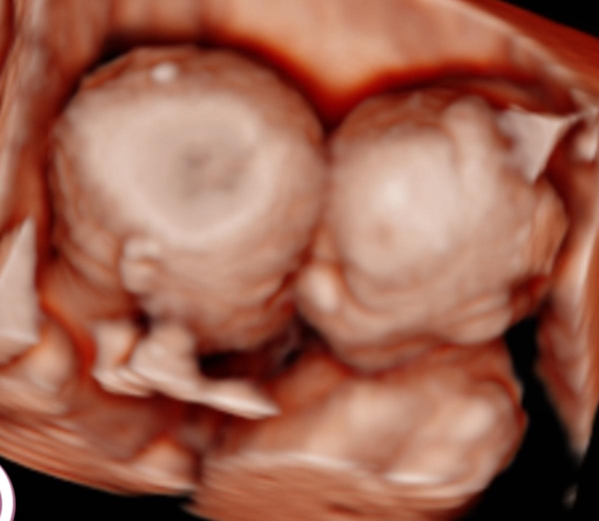 Expect Two New Babies Next Year—Wife’s Heroic Journey