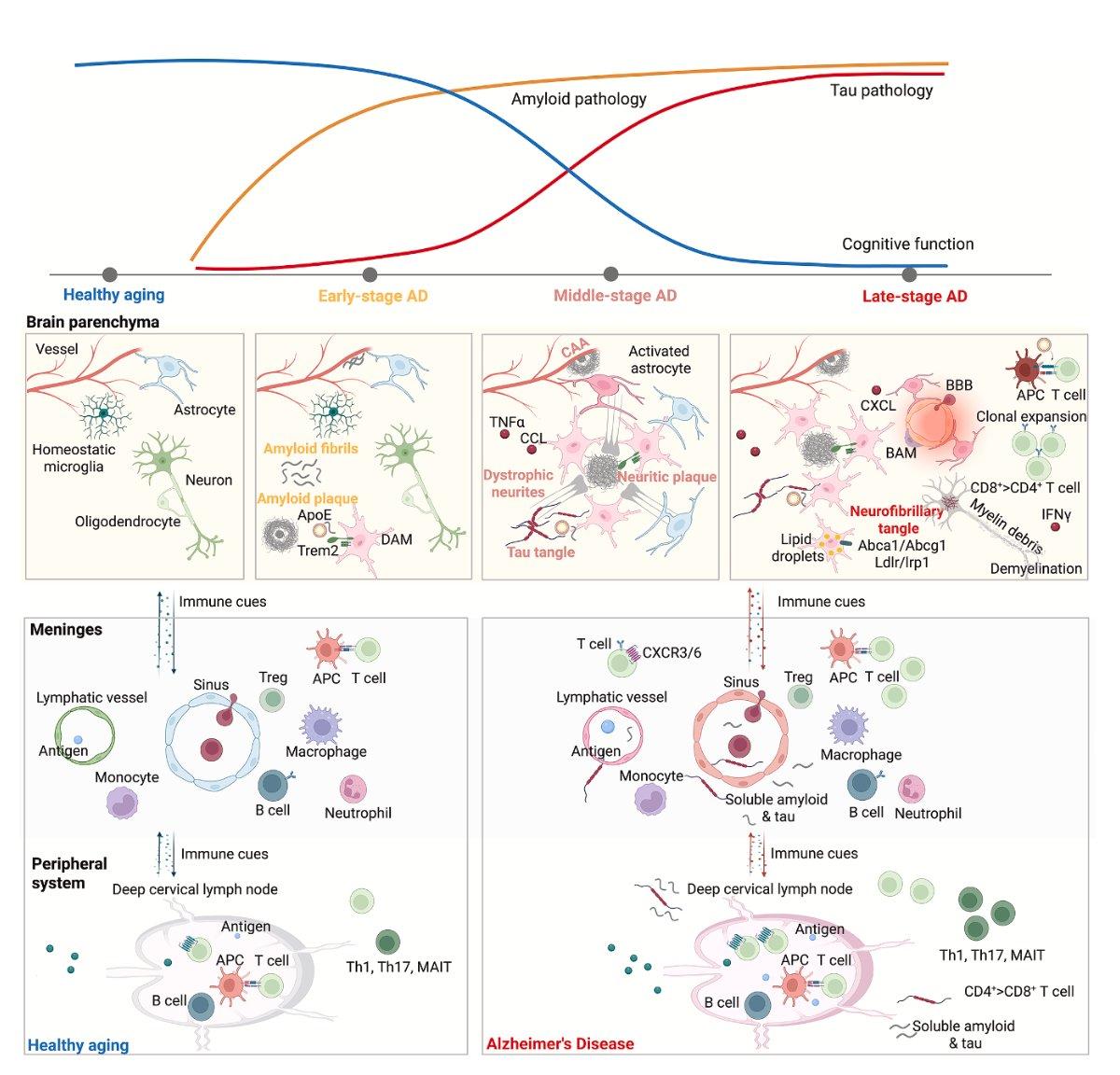 Immune Cells Drive Transition From Healthy Aging to Alzheimer’s