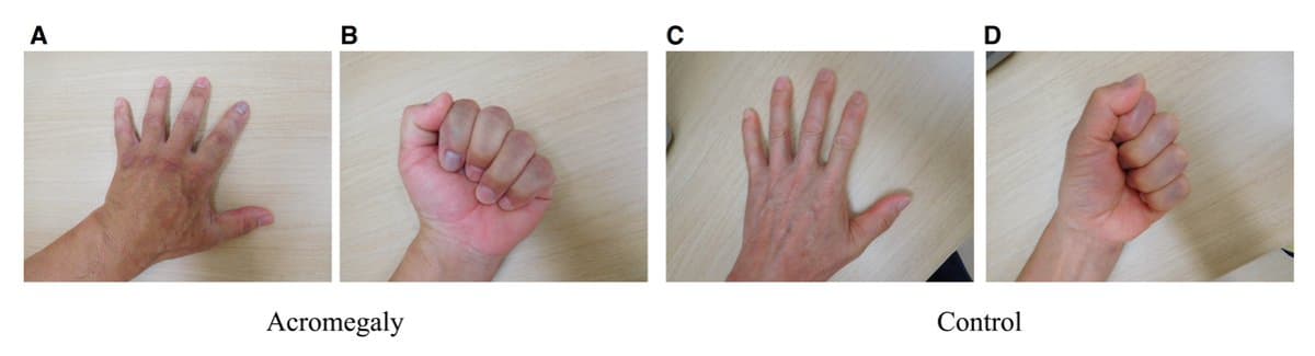 Smartphone AI Beats Endocrinologists in Acromegaly Diagnosis