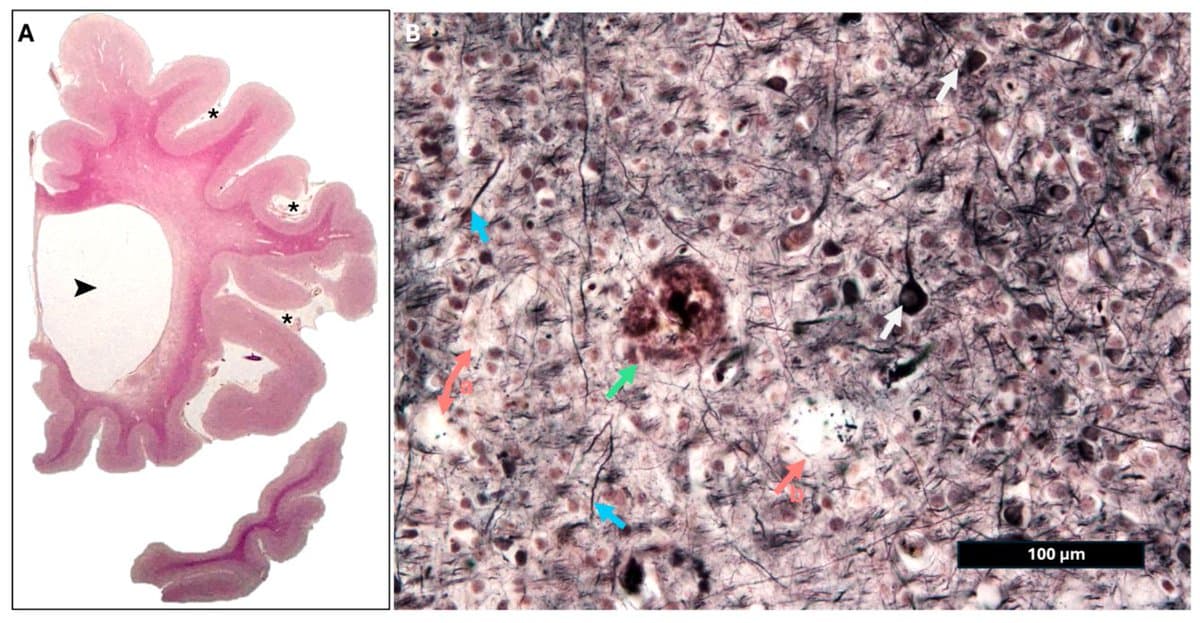 Glymphatic Failure Links Dog Dementia to Alzheimer’s