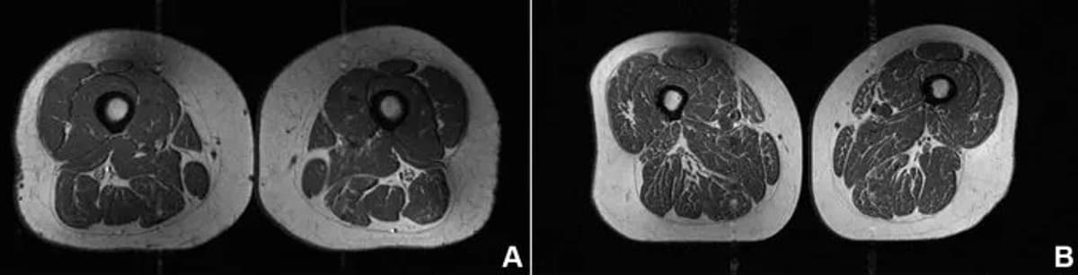 Ultraprocessed Diet Turns Thighs Into Marbled Steak