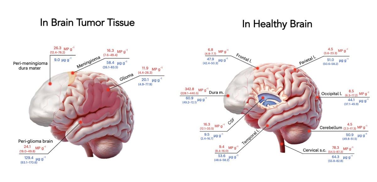 Microplastics Ubiquitous in Brains, Concentrate Near Tumors