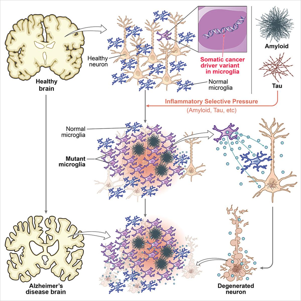 Cancer-Like Microglial Mutations May Fuel Alzheimer's Inflammation