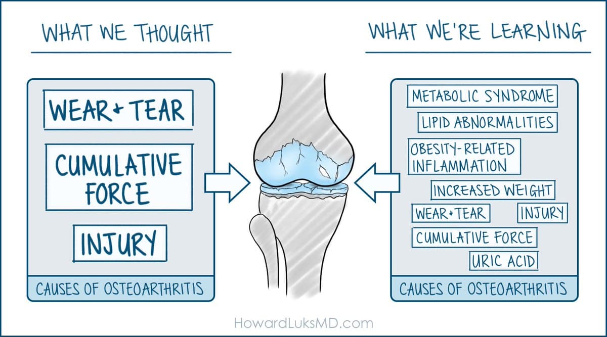 Metabolic Health Drives Knee Osteoarthritis Progression