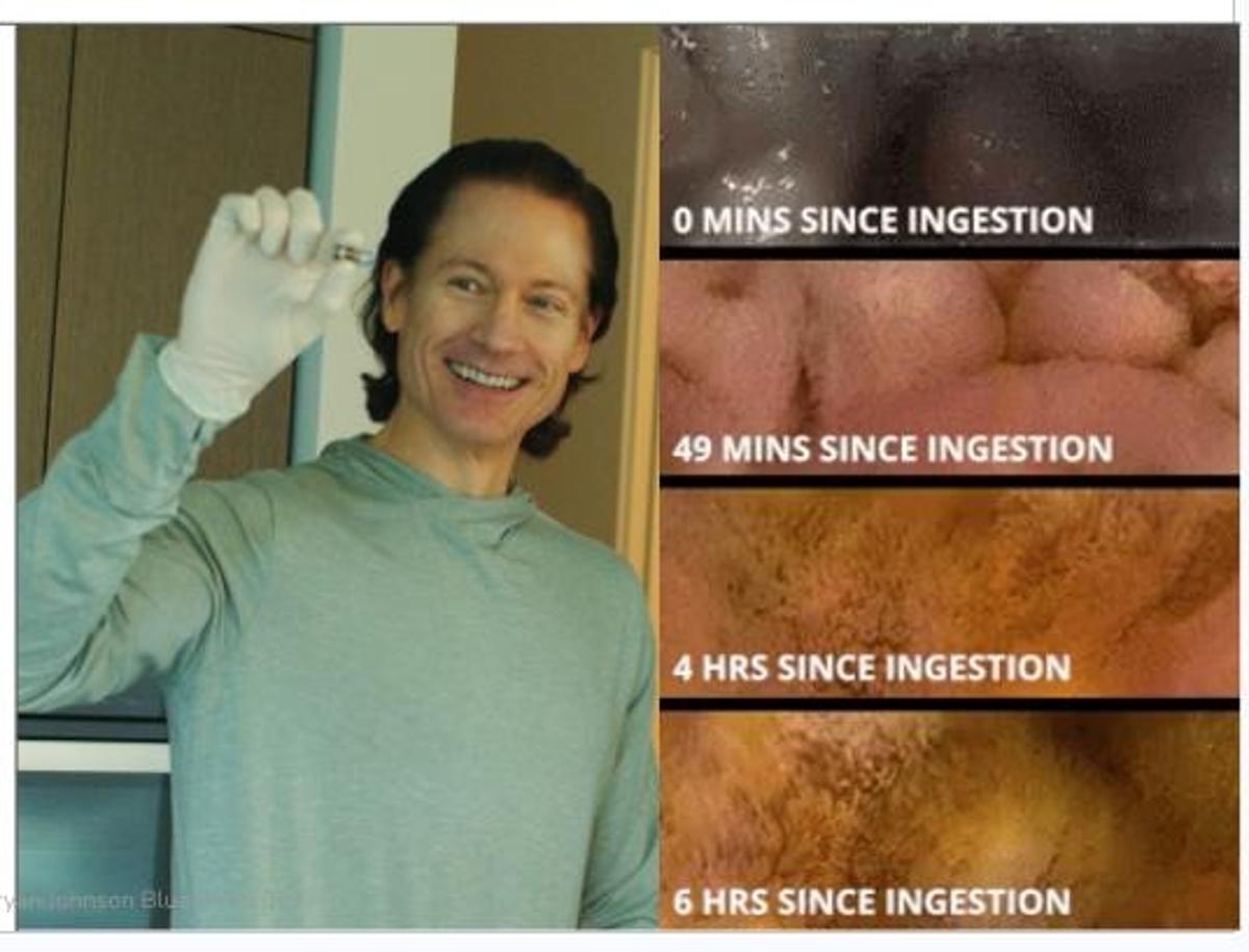 10‑hour Pill Camera Finds No Abnormalities, Next Endoscopy Scheduled