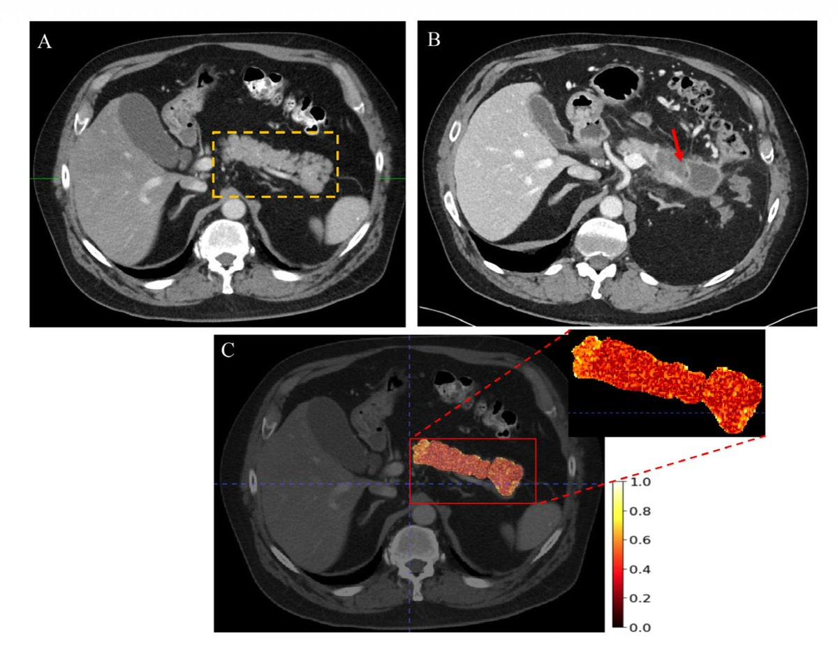 AI Detects Hidden Pancreatic Cancer at 73% Accuracy