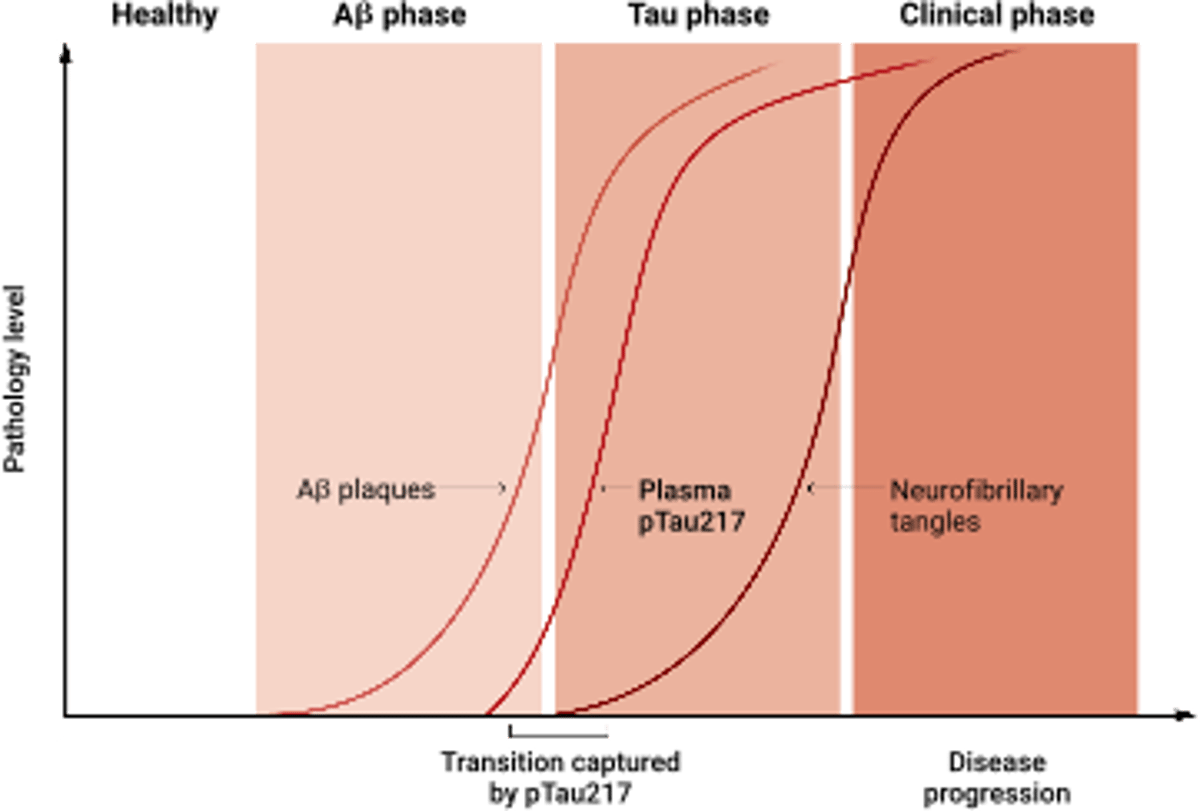 Blood Test Pinpoints Amyloid‑to‑tau Transition in Alzheimer’s