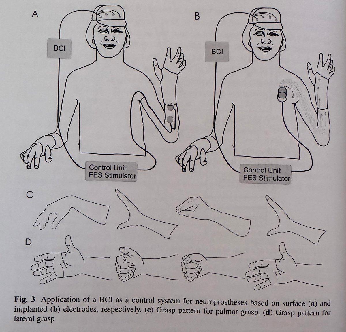 BCI Controls Neuroprosthetic Grasps via Surface and Implanted Electrodes